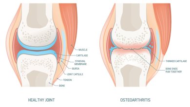 What Is The Most Effective Treatment For Osteoarthritis?