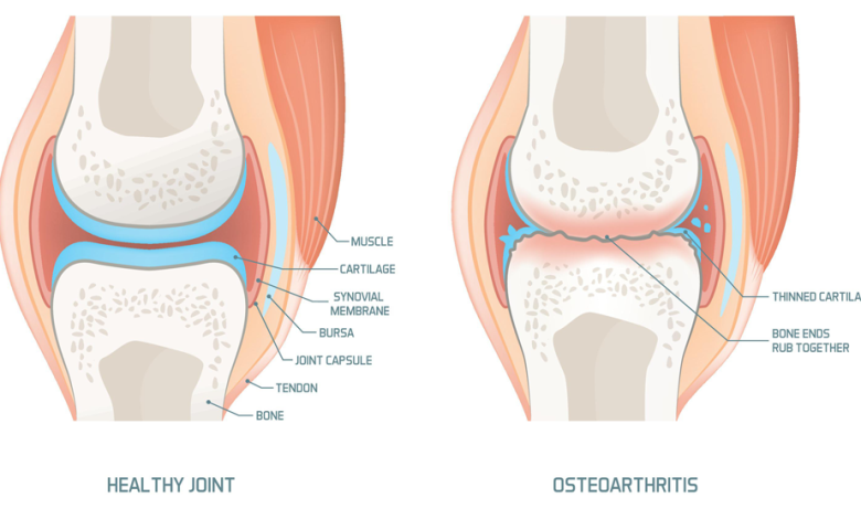 What Is The Most Effective Treatment For Osteoarthritis?